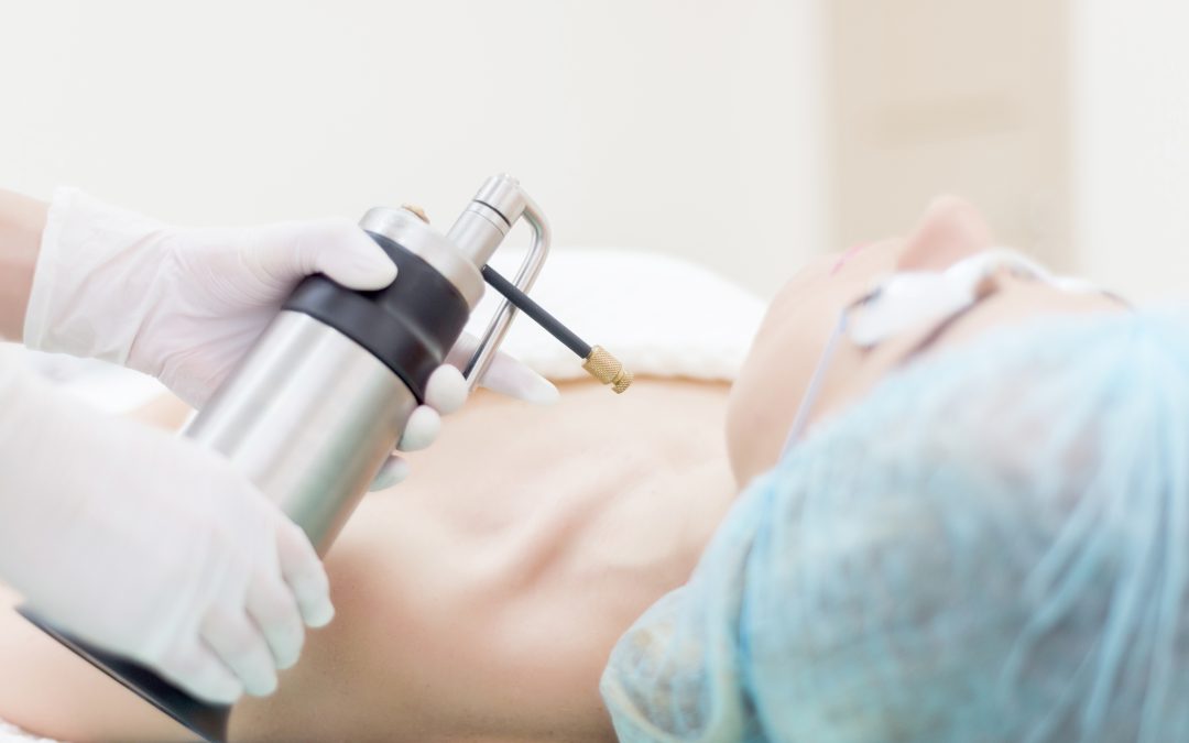 A Guide to Skin Tag Removal in New Zealand